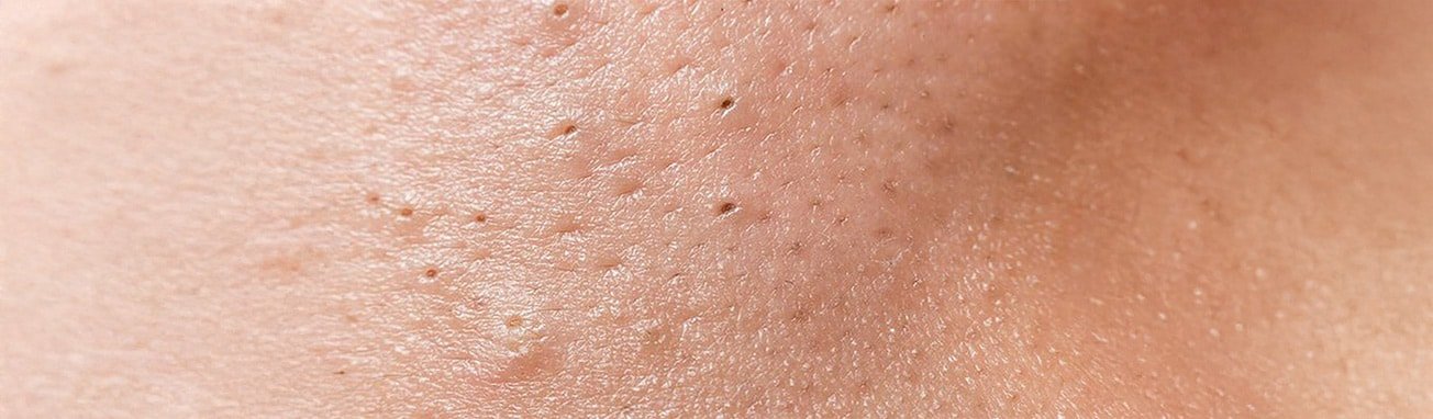 Artikel over acne - hoofdpagina