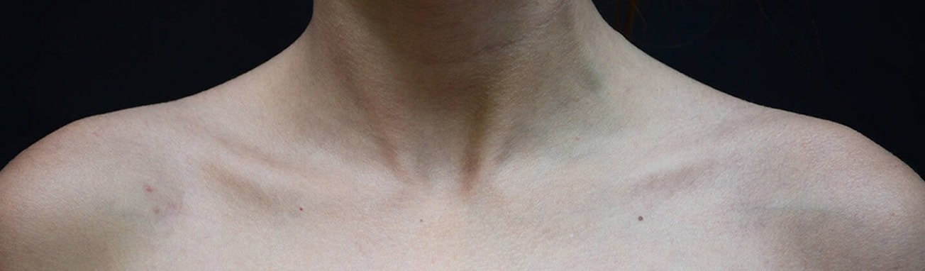Artikel over acne - hoofdpagina