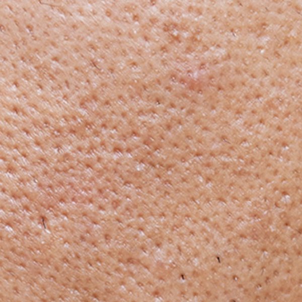 Artikel over acne - hoofdpagina