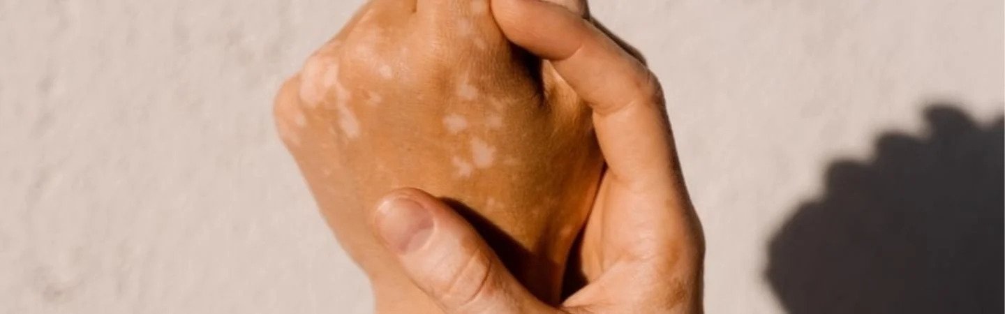 soins-de-la-peau-pour-lhyperpigmentation-03
