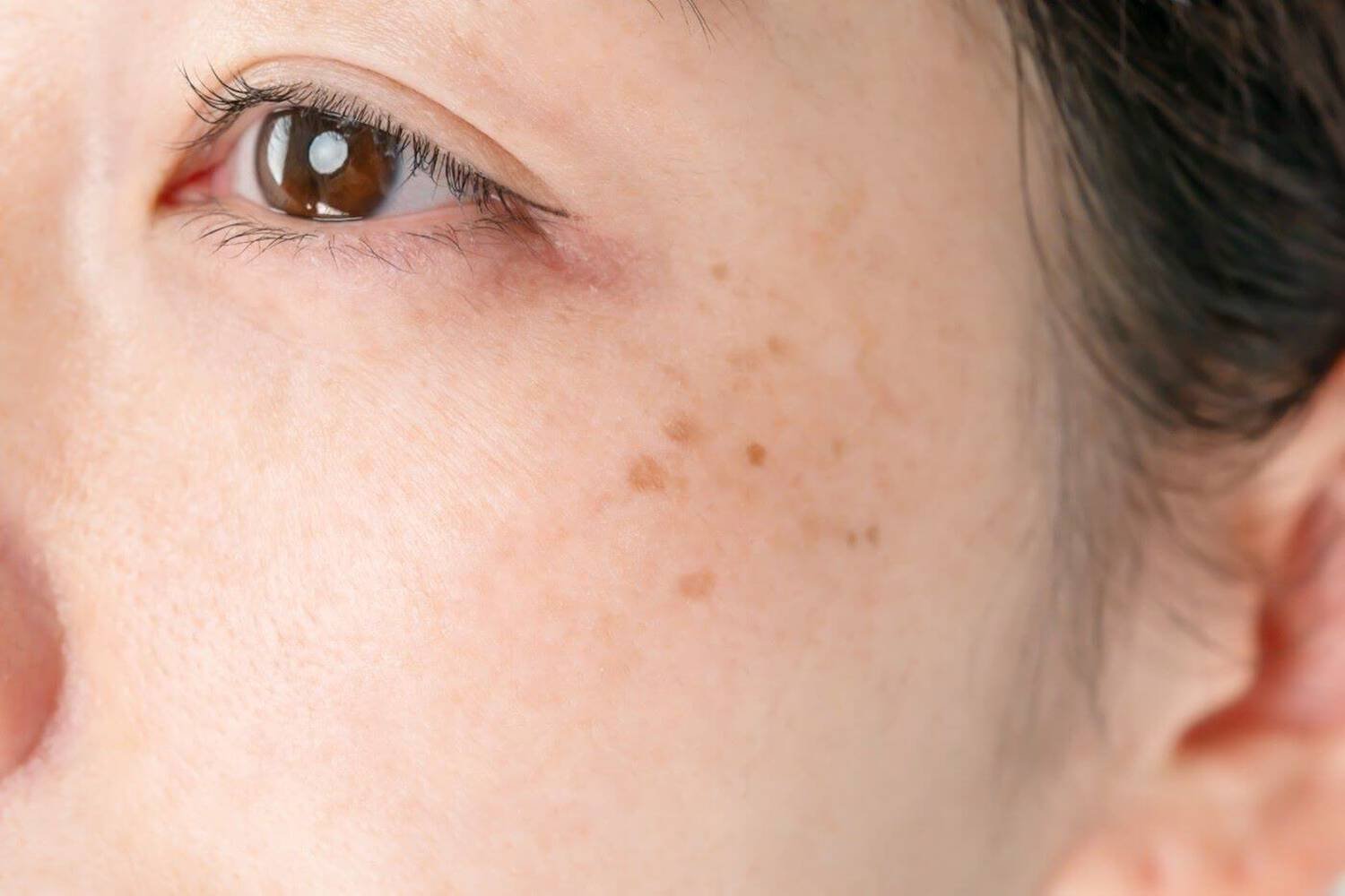 pigmentation-peau_6