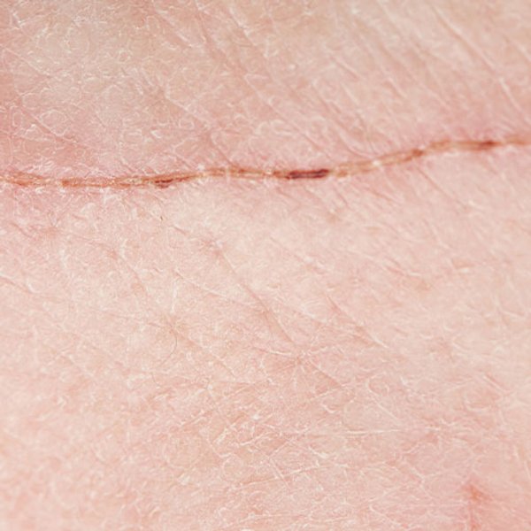 Artikel over de huid met neiging tot acne - hoofdafbeelding
