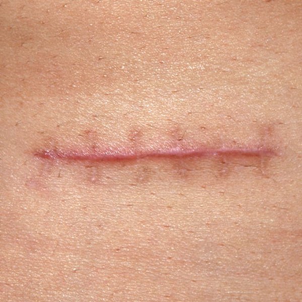 Hoe lang blijven oplosbare hechtingen zitten?