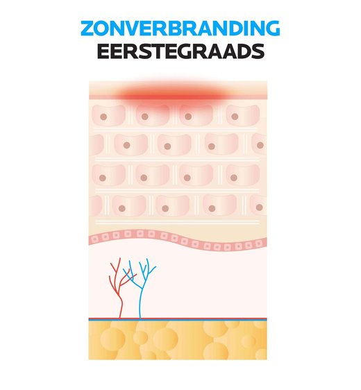 Zonverbranding eerstegraads