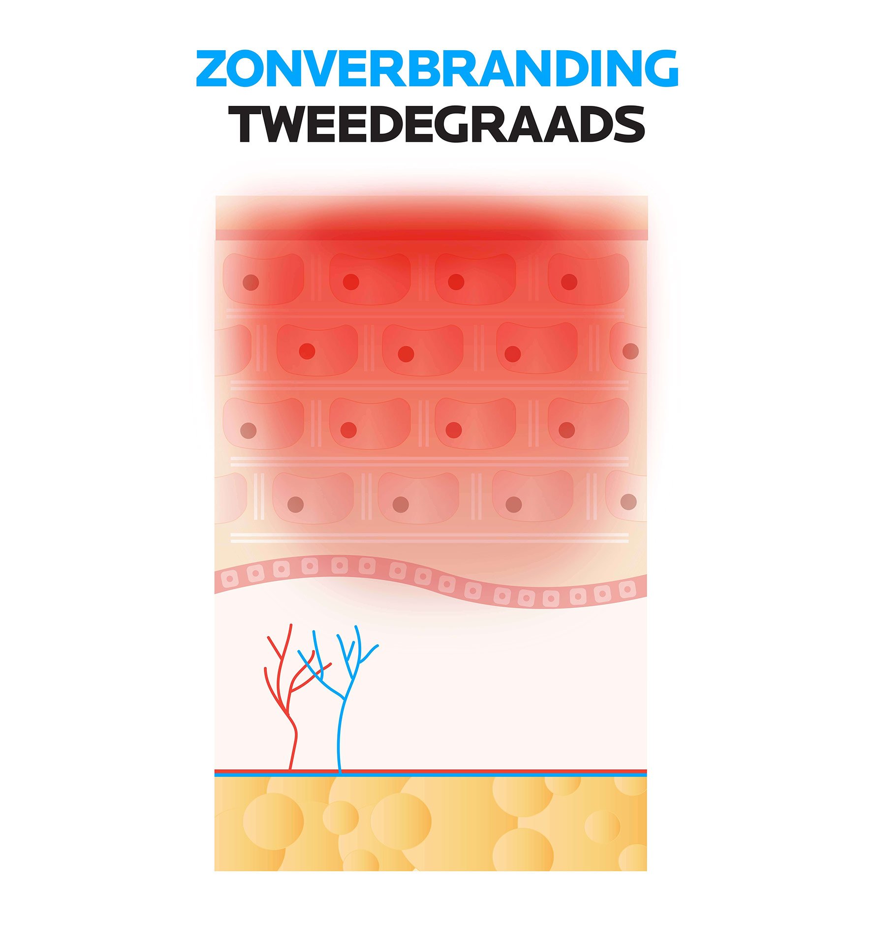 Zonverbranding tweedegraads