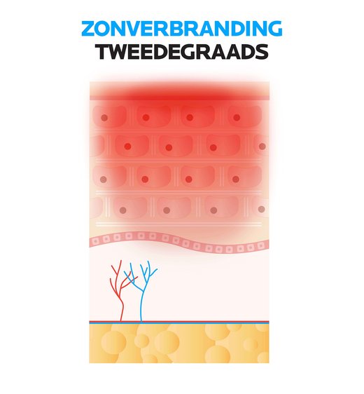 Zonverbranding tweedegraads