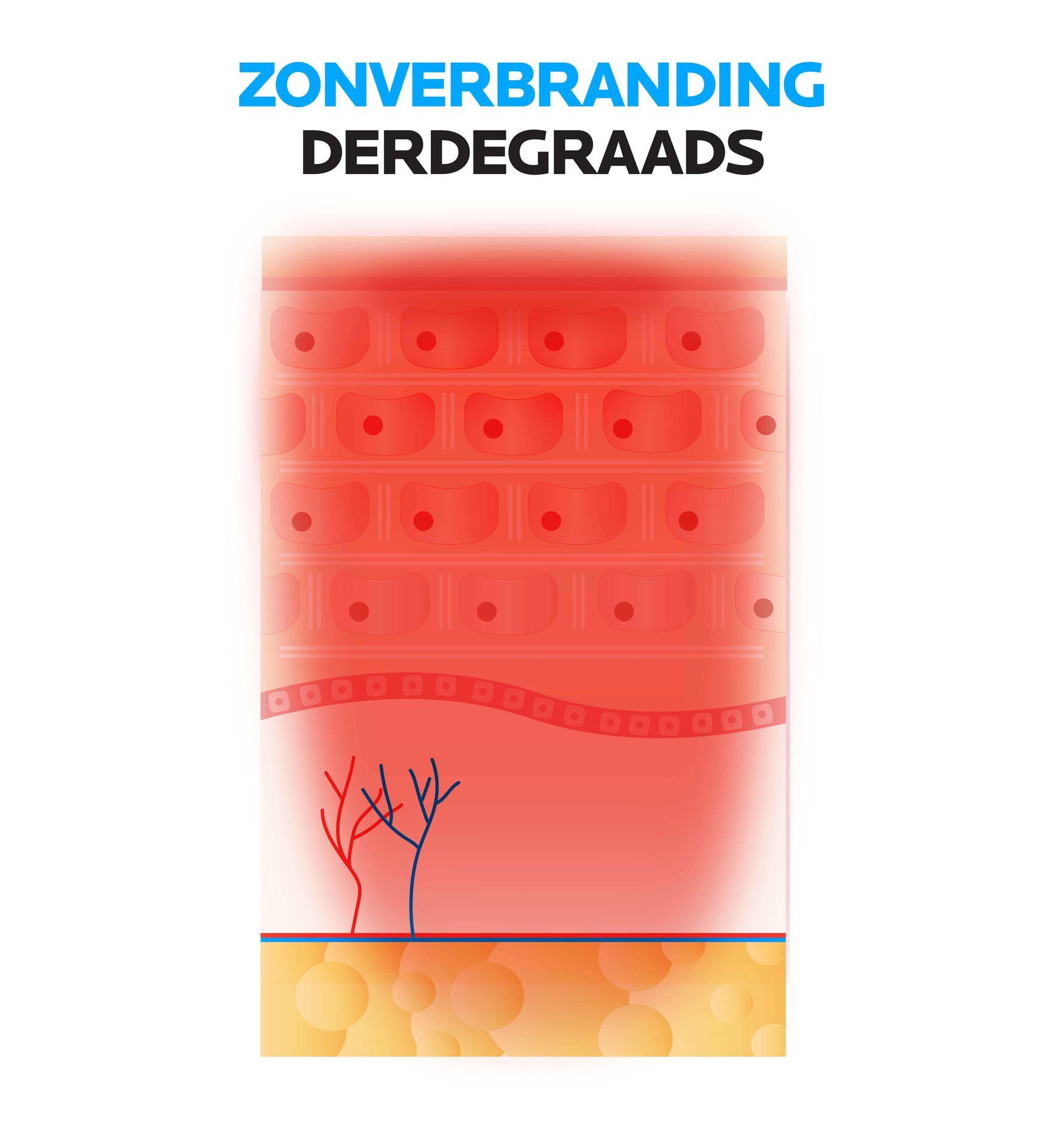 Zonverbranding derdegraads