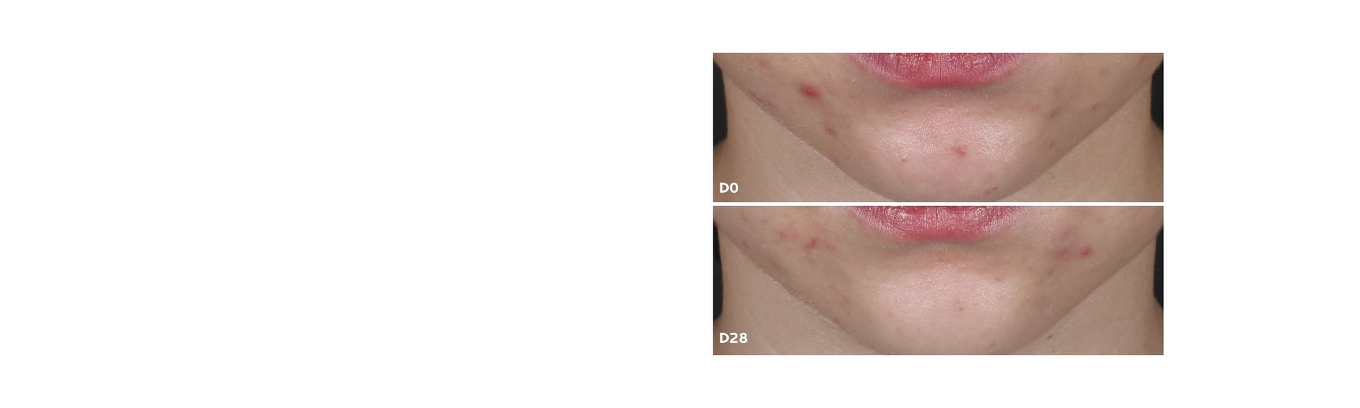 COMMITMENT_ACNE BANNER